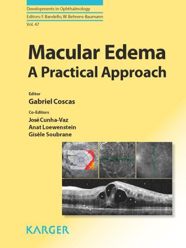 Macular Edema A Practical Approach.
