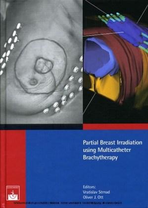 Partial Breast Irradiation using Multicatheter Brachytherapy 